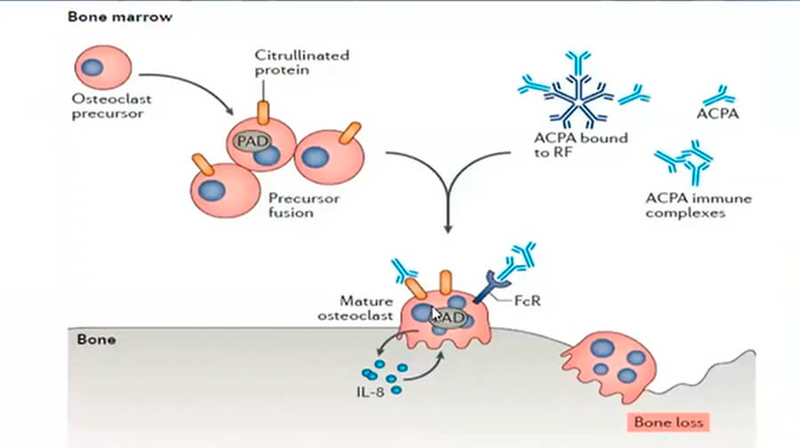 El papel del laboratorio en el diagnóstico de la artritis reumatoidea, fundamentos y perspectivas